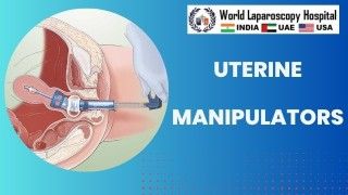 Uterine Manipulators: Understanding the Importance of this Essential Surgical Tool