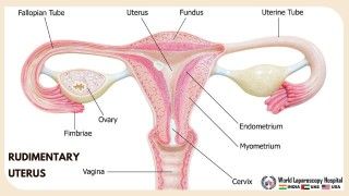 Understanding the Rudimentary Uterus: Causes, Symptoms, and Treatment Options