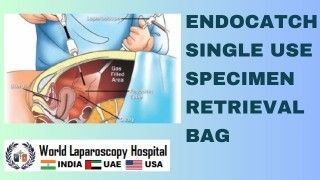 Endocatch Single Use Specimen Retrieval Bag: A Must-Have Tool for Laparoscopic Surgery.