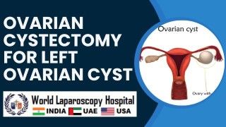 Surgical Procedure for Left Ovarian Cyst Removal: Ovarian Cystectomy Explained