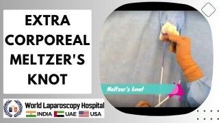 Mastering the Extra Corporeal Meltzer's Knot: Advanced Laparoscopic Suturing Techniques.