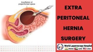 Exploring Extra-Peritoneal Hernia Surgery: Techniques and Outcomes for Improved Patient Recovery