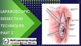 Advanced Laparoscopic Dissection Techniques: Safe and Effective Surgery Part 2