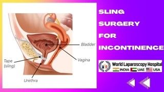 Sling Surgery for Incontinence: An Effective Treatment Option for Improved Quality of Life