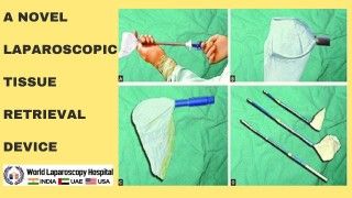 Innovative Laparoscopic Surgery: A Novel Tissue Retrieval Device