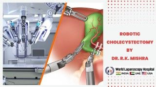 Experience the Future of Surgery: Robotic Cholecystectomy by Dr. R.K. Mishra