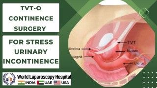 Laparoscopic Assisted Orcheopexy for Undescended testes Demonstration by Dr R K Mishra