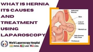 Understanding Hernia: Causes and Minimally Invasive Treatment with Laparoscopy