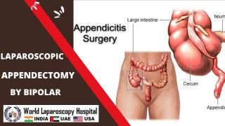 Laparoscopic Cholecystectomy using Mishra's Knot