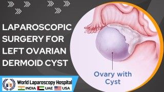 Tackling Left Ovarian Dermoid Cyst: Laparoscopic Surgery at Its Finest