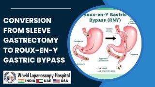 Laparoscopic Repair of Large Hiatus Hernia Lecture by Dr R K Mishra