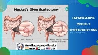 Laparoscopic Meckel's Diverticulectomy: Effective Management for Symptomatic Meckel's Diverticula