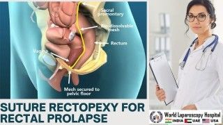 Laparoscopic Cholecystectomy High definition Video by Dr. R.K. Mishra