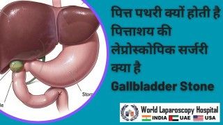 पित्त पथरी: कारण और पित्ताशय की लेप्रोस्कोपिक सर्जरी के बारे में जानें