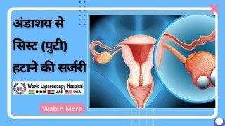अंडाशय से सिस्ट (पुटी) को निकालने के लिए ऑपरेशन