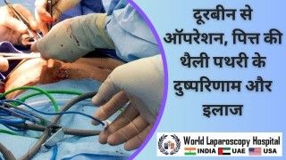 पित्त की थैली पथरी: दूरबीन से ऑपरेशन, दुष्परिणाम और इलाज के प्रमुख पहलुओं का विश्लेषण