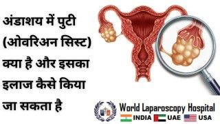 अंडाशय में पुटी (ओवरियन सिस्ट): परिभाषा और इलाज के विधियाँ