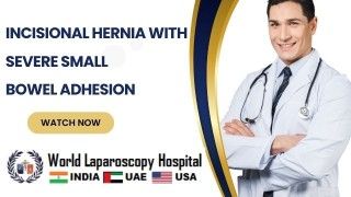 Managing Recurrent Incisional Hernia with Severe Small Bowel Adhesion and Subacute Obstruction