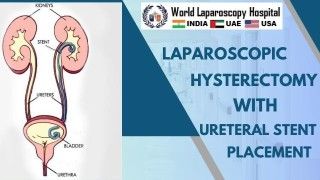 Laparoscopic Hysterectomy with Ureteral Stent Placement for Optimal Patient Care