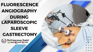 Illuminating Laparoscopic Sleeve Gastrectomy for Optimal Surgical Precision