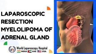 Advances in Laparoscopic Resection of Adrenal Gland Myelolipoma: A Minimally Invasive Approach