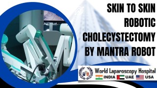 Robotic Surgery Advancement: Emergence of Skin to Skin Robotic Cholecystectomy Using Mantra Robot
