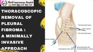 Minimally Invasive Thoracoscopic Resection of Pleural Fibroma: A Modern Surgical Approach