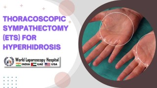 ETS for Hyperhidrosis: Step-by-Step Surgical Guide – WLH