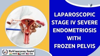 Advanced Laparoscopic Surgery for Stage IV Severe Endometriosis & Frozen Pelvis at WLH