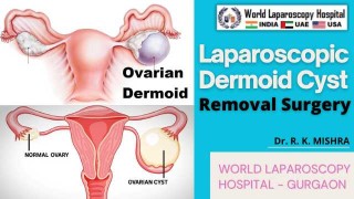 WLH Expertise in Dermoid Cyst Removal | Minimally Invasive Laparoscopic Ovarian Surgery