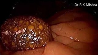 Laparoscopic Cholecystectomy for Stone impacted at Hartmann's pouch