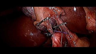 Laparoscopic Cholecystectomy for Short Cystic Duct by Mishra's Knot