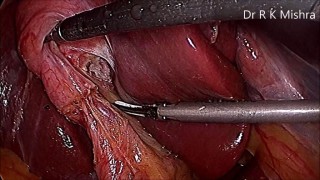Mishra's Knot - Ideal for Laparoscopic Cholecystectomy