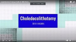 Laparoscopic Management of CBD Stone