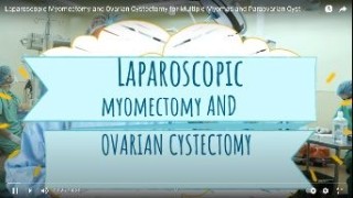 Laparoscopic Myomectomy and Ovarian Cystectomy for Multiple Myomas and Paraovarian Cyst