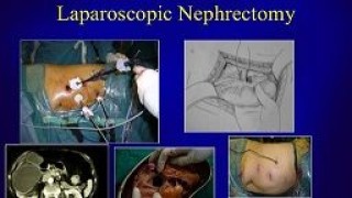 Laparoscopic Nephrectomy