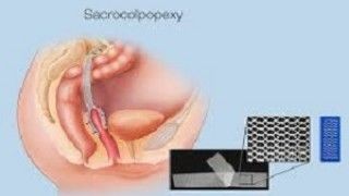 Sacrocolpopexy with hysterectomy using mesh for uterine prolapse repair