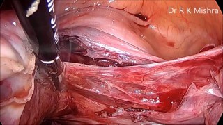 Total Laparoscopic Hysterectomy (TLH) with Infrared Ureteral Stent