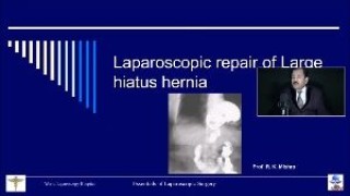 Laparoscopic Mesh Repair of Giant Hiatus hernia