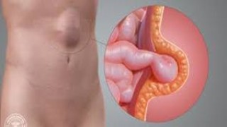 Laparoscopic Repair of Lumber Incisional Hernia