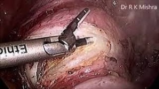 Total Laparoscopic Hysterectomy with Bilateral Salpingo Oophorectomy