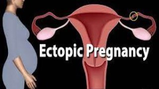 Laparoscopic Salpingotomy for Ectopic Pregnancy