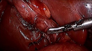 Mucocele of Gallbladder with Impacted Stone at Neck Operated by Mishra's Knot