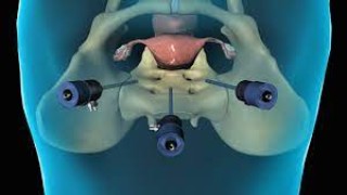 Laparoscopic Hysterectomy with Bilateral Salpingo-oophorectomy and Vault Closure with Weston Knot