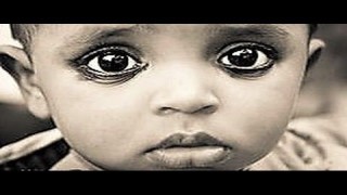 Minimal Invasive Pediatric Surgery Lecture by Dr R K Mishra