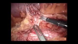 Laparoscopic Colorectal Surgery Part 2 Lecture by Dr R K Mishra