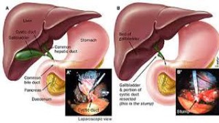 Laparoscopic Cholecystectomy for Stump Cholecystitis
