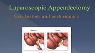 Laparoscopic Appendicectomy by Dr R K Mishra