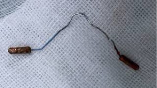Laparoscopic Removal of a Perforated Intrauterine Device by Dr. R.K. Mishra