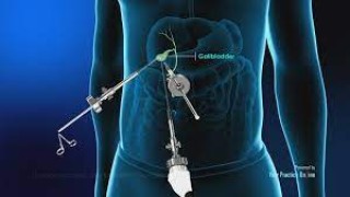Laparoscopic Surgery for Gall Stone